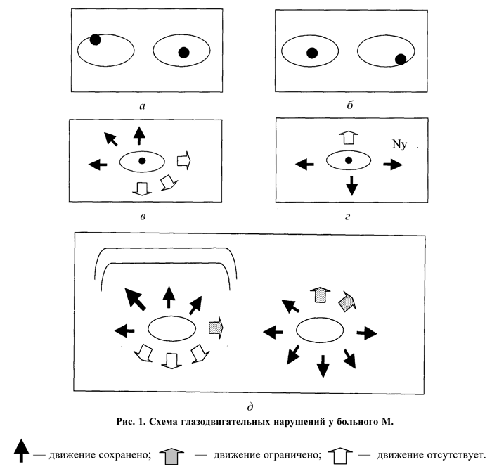 Межъядерная офтальмоплегия фото